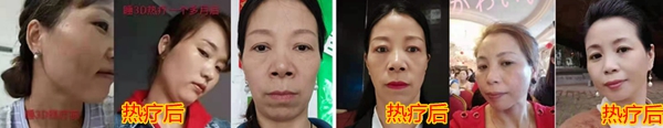 睡热疗美容效果000.jpg
