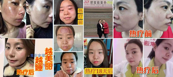 睡热疗美容效果002.jpg