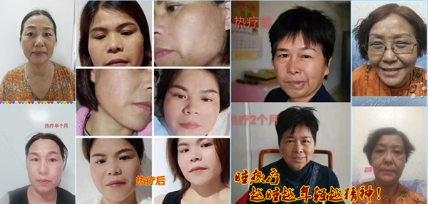 睡热疗美容效果008.jpg