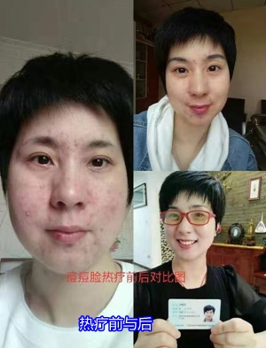 顾客反映：我的痘痘脸变成白嫩脸（七）